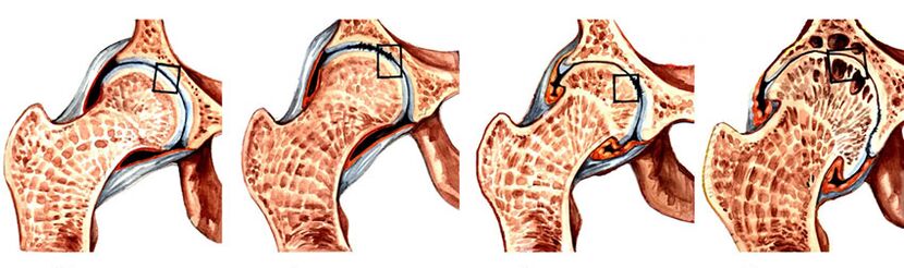 Степень развития остеоартроза тазобедренного сустава. 