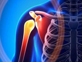 Опухший плечевой сустав из-за остеоартрита — хронического заболевания опорно-двигательного аппарата. 